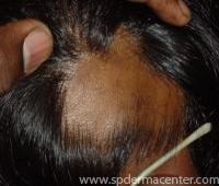 Alopecia-Before
